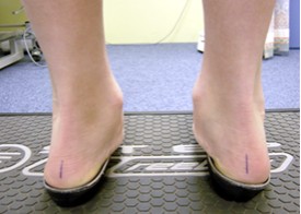 Photo of feet with orthotics