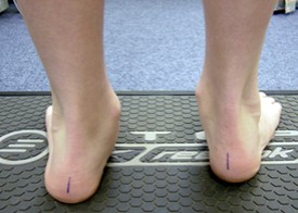 Photo of pronated feet